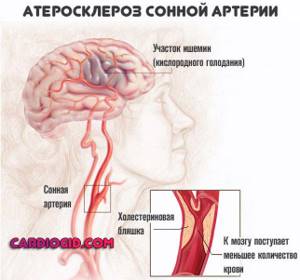 атеросклероз-сонной-артерии