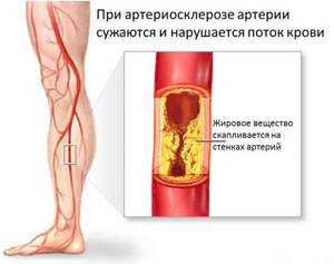 Атеросклероз ног. лечение