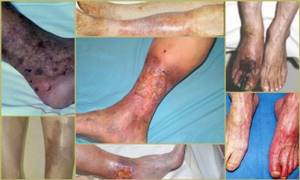 Осложнения атеросклероза ног
