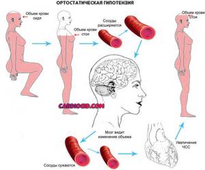 ортостатическая-гипотензия