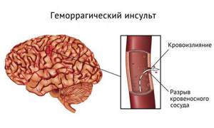 Опасность кровоизлияния в мозг и последствия патологии
