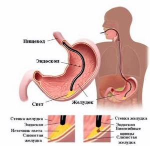 эндоскопия желудка