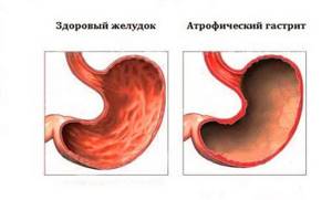 Операция при раке в желудке на 3 стадии и продолжительность жизни после нее