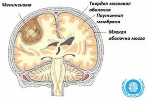 Опухоль головного мозга менингиома: признаки, причины, лечение