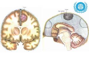 Опухоль головного мозга менингиома: признаки, причины, лечение