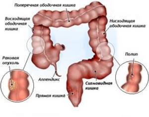 Опухоль кишечника: симптомы, диагностика и лечение