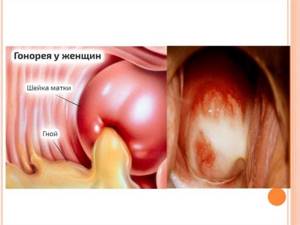 Острый вагинит: лечение, причины, симптомы, признаки, фото