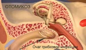 Отомикоз: симптомы и лечение грибка в ушах у человека
