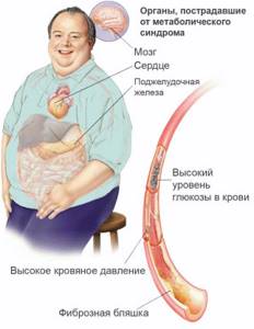 Ожирение поджелудочной железы: что это такое и как её лечить