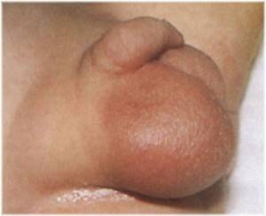 Паховая грыжа у ребенка. Фото 1, 2, 3 года, 5 лет. Лечение народными средствами, операция