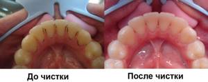 Устранение зубных отложений при пародонтите