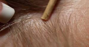 Педикулез или вшивость: что это такое, какие симптомы появления вшей, как лечить заболевание в домашних условиях?