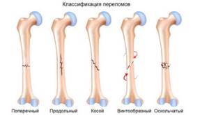 Виды переломов кости по характеру разлома