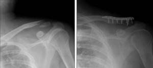 Рентген ключицы до и после остеосинтеза