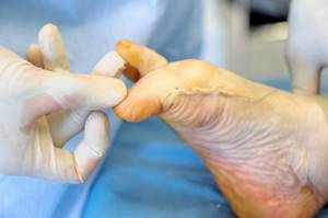 Хирургическое вмешательство перелома пальца ноги
