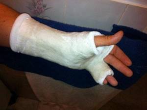 Перелом пальца на руке: симптомы, диагностика, лечение, реабилитация