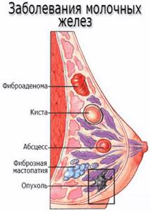 Заболевания молочных желез - мастопатия, кисты, фиброаденома
