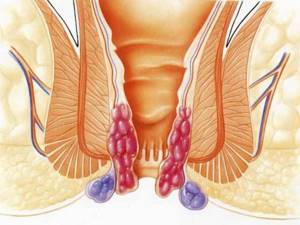Сужение стенок кишечника может привести к раку (фото: pancreatit.info)