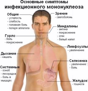 Основные симптомы инфекционного мононуклеоза
