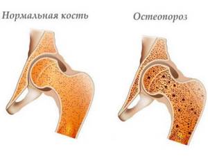 Развитие остеопороза