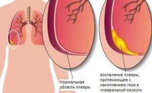 Почему больно дышать: при вдохе болит справа в грудной клетке