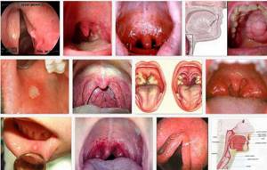 Почему горло болит? Ларингит, тонзиллит, фарингит и еще 6 причин