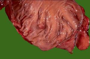 Тубулярная аденома кишечника в разрезе