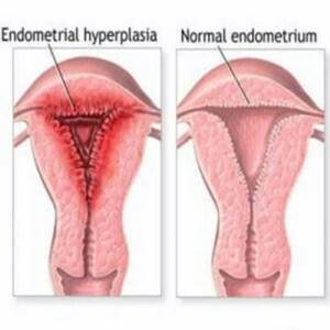 Гиперплазия эндометрия