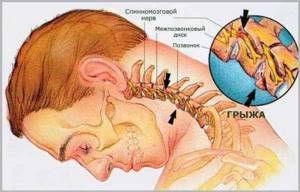 лечение грыжи в шее