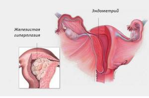 гиперплазия матки