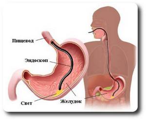 Как делают гастроскопию желудка