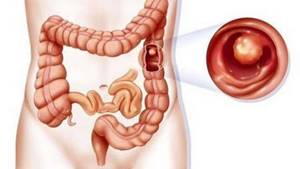 Полипы в кишечнике — первые симптомы и проявления, лечение