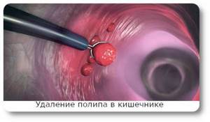 Удаление полипов в кишечнике эндоскопическим методом