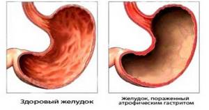 Пониженная кислотность желудка: симптомы и лечение