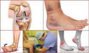 Посттравматический артроз голеностопного и коленного суставов