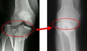 Посттравматический артроз голеностопного и коленного суставов