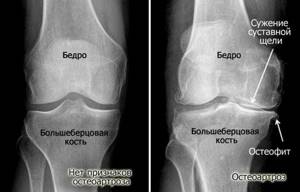 Причины болей в суставах ног и эффективные методы лечения