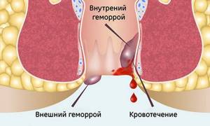 Кровотечение из внутренних геморроидальных шишек