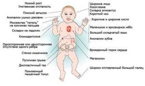 Причины и признаки синдрома Дауна — диагностика у плода при беременности, развитие ребенка и меры профилактики