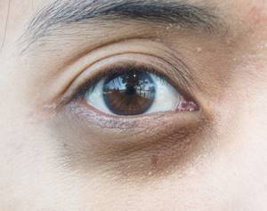 Причины появления черных кругов под глазами у человека