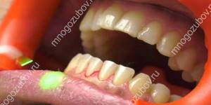 Лазерная чистка зубов от налета