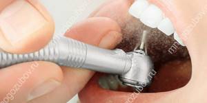 Чистка зубов Эйр-Фло