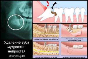Альвеолит после удаления зуба в самом начале воспалительного процесса
