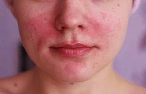 Причины появления красных пятен на лице у детей и взрослых — лечение
