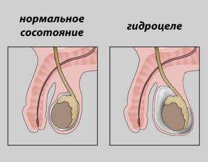 Водянка яичка у мужчин - причины, симптомы на фото и лечение
