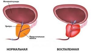 Patologija-prostaty