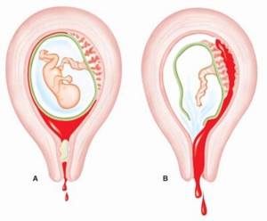 Признаки, лечение и последствия ретрохориальной гематомы при беременности