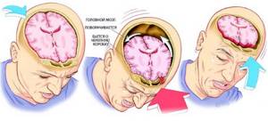 Признаки сотрясения мозга у взрослого человека через несколько минут, часов, дней после удара. Первая помощь, лечение, препараты, последствия
