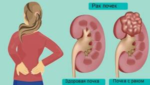 Боль в спине при раке почки