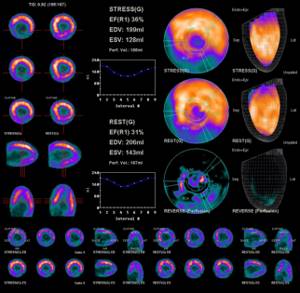 Изотопная томография сердца